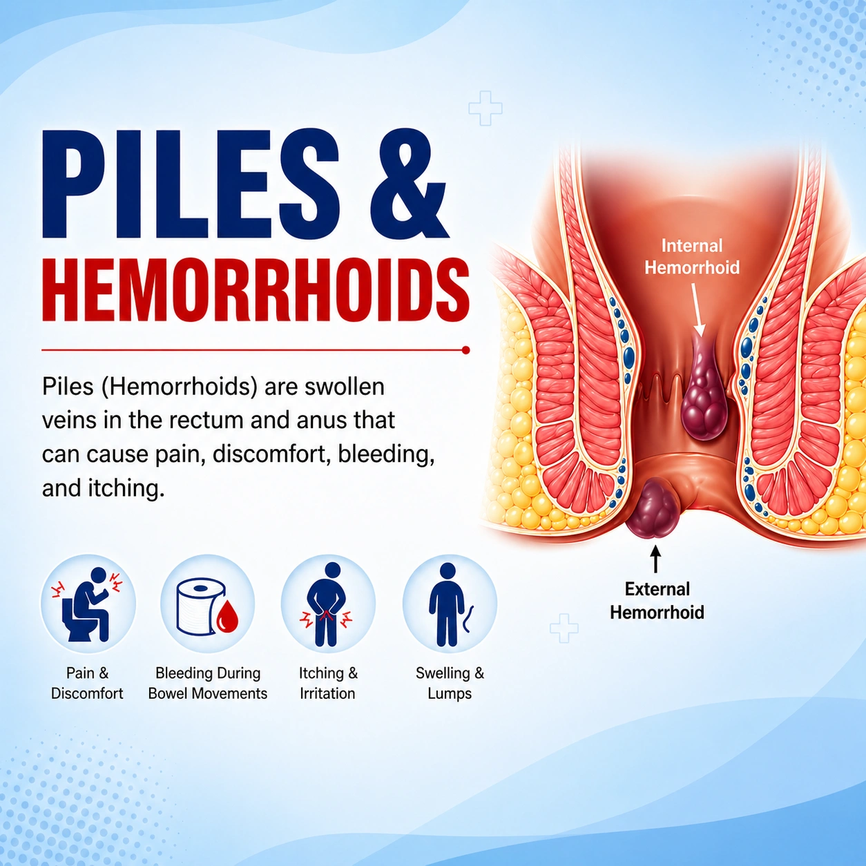 Piles & Harmorrhoides